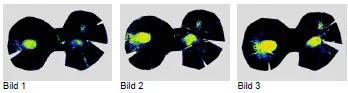 Biomechanics Abb. 30: Falschfarbendarstellung der selben Kontaktflächen bei den gleichen Belastungsstufen (W2-26, rechts) Bild 1: Kontaktfläche in der Belastungsstufe 150%, 471N; Bild 2: Kontaktfläche in der Belastungsstufe 200%, 628N; Bild 3: Kontaktfläche in der Belastungsstufe 250%, 785N
